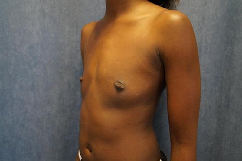 Breast Augmentation Before & After Gallery - Patient 201450 - Image 3