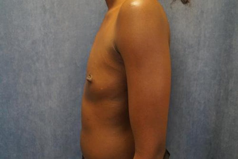 Breast Augmentation Before & After Gallery - Patient 201450 - Image 5