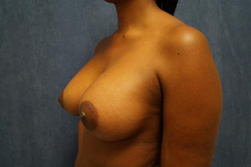 Breast Augmentation Before & After Gallery - Patient 101407 - Image 4