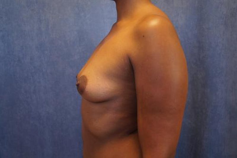 Breast Augmentation Before & After Gallery - Patient 101407 - Image 5