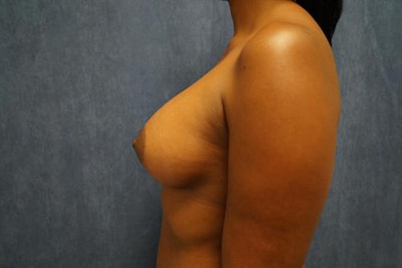 Breast Augmentation Before & After Gallery - Patient 101407 - Image 6