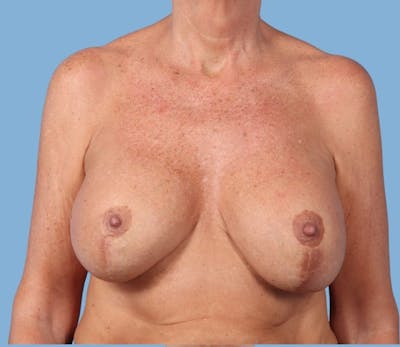 Internal Bra Technique Before & After Gallery - Patient 310895 - Image 1