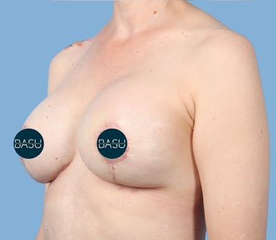 Internal Bra Technique Before & After Gallery - Patient 421560 - Image 2