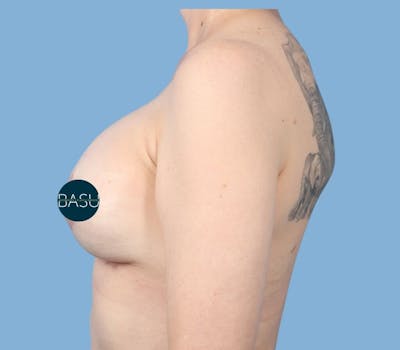 Internal Bra Technique Before & After Gallery - Patient 329893 - Image 2