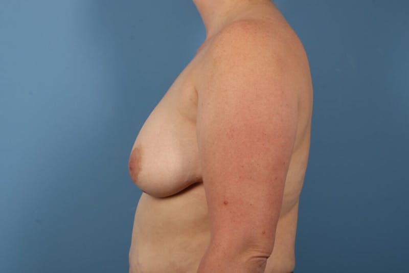 Internal Bra Technique Before & After Gallery - Patient 412307 - Image 5