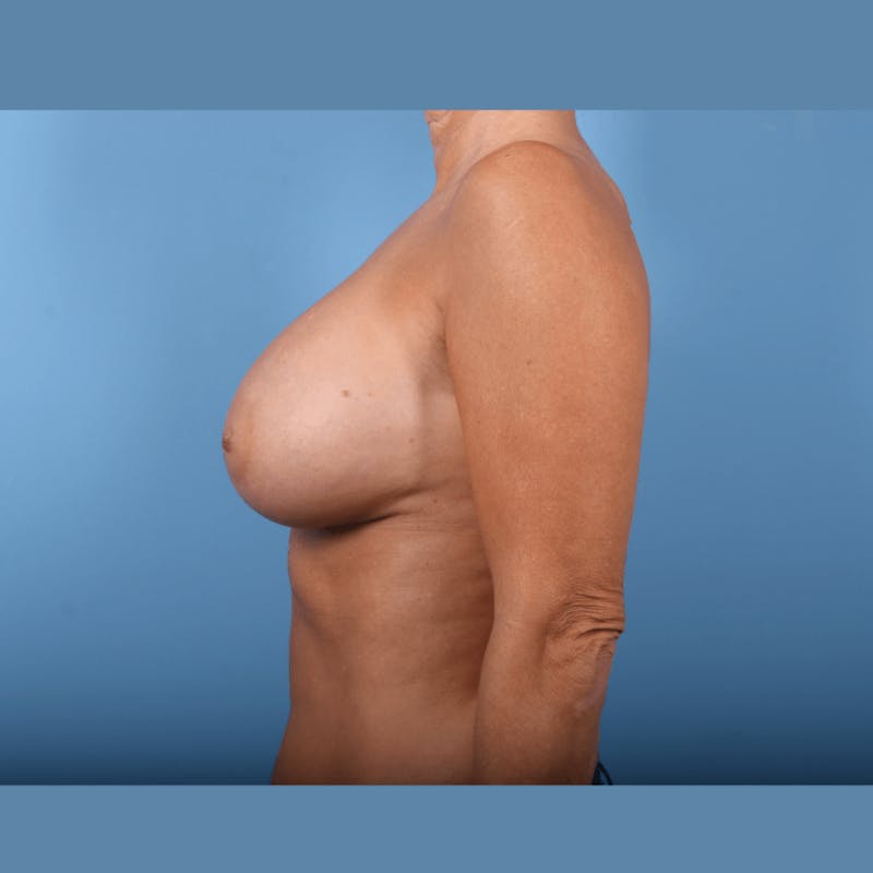 Internal Bra Technique Before & After Gallery - Patient 423278 - Image 5