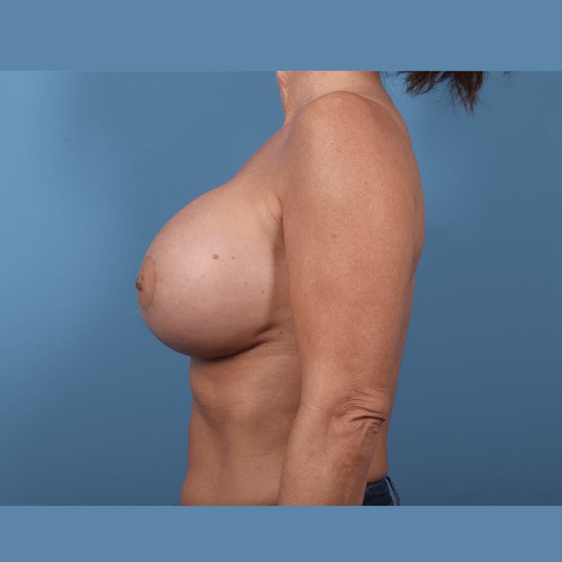 Internal Bra Technique Before & After Gallery - Patient 423278 - Image 6