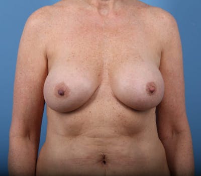 Internal Bra Technique Before & After Gallery - Patient 367507 - Image 1