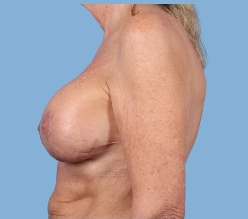 Breast Augmentation with Lift Before & After Gallery - Patient 155384 - Image 2