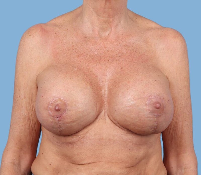 Breast Augmentation with Lift Before & After Gallery - Patient 263521 - Image 2