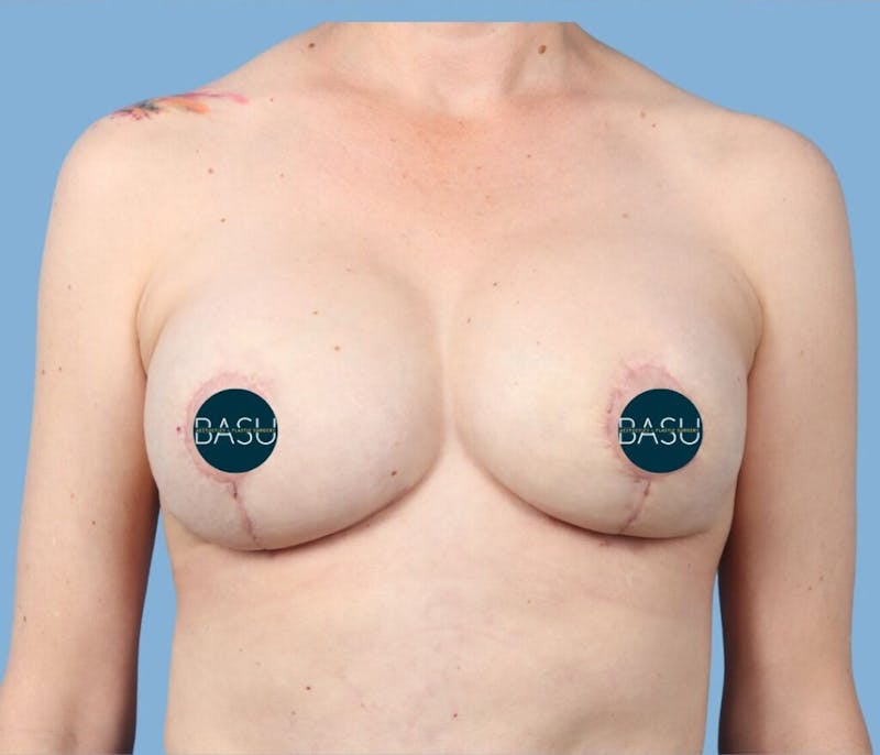 Breast Augmentation with Lift Before & After Gallery - Patient 274615 - Image 2