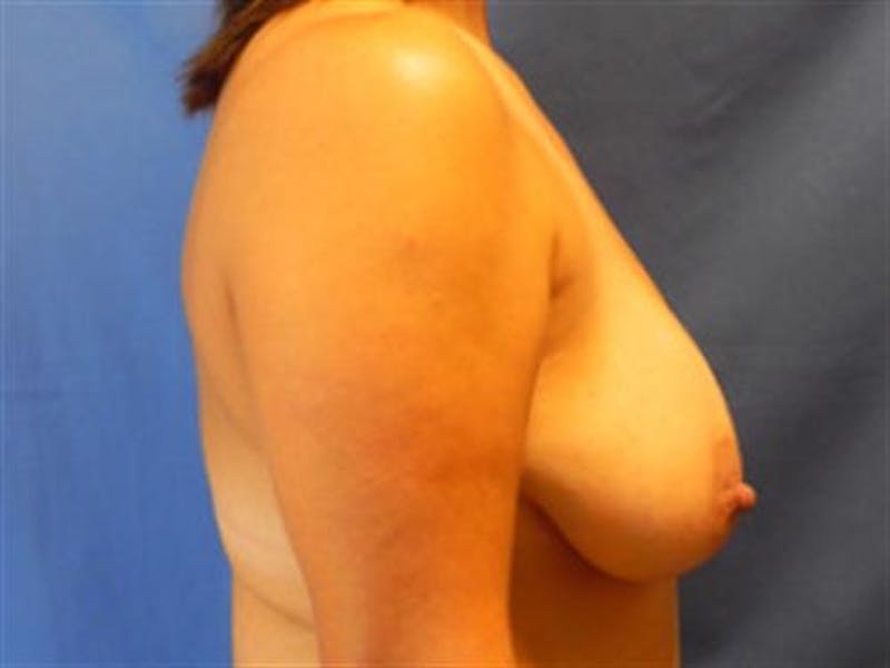 Breast Augmentation with Lift Before & After Gallery - Patient 198246 - Image 3