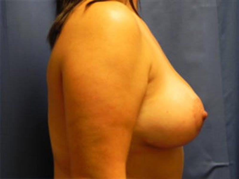 Breast Augmentation with Lift Before & After Gallery - Patient 198246 - Image 4