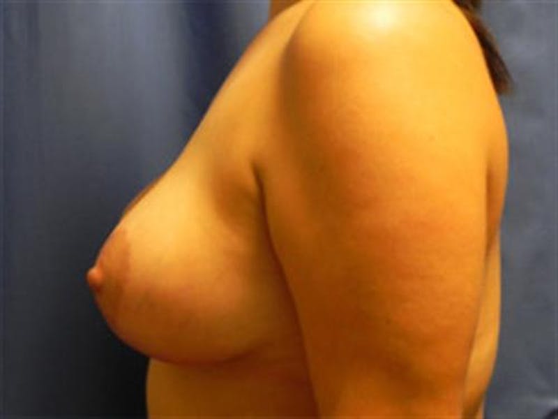 Breast Augmentation with Lift Before & After Gallery - Patient 198246 - Image 6