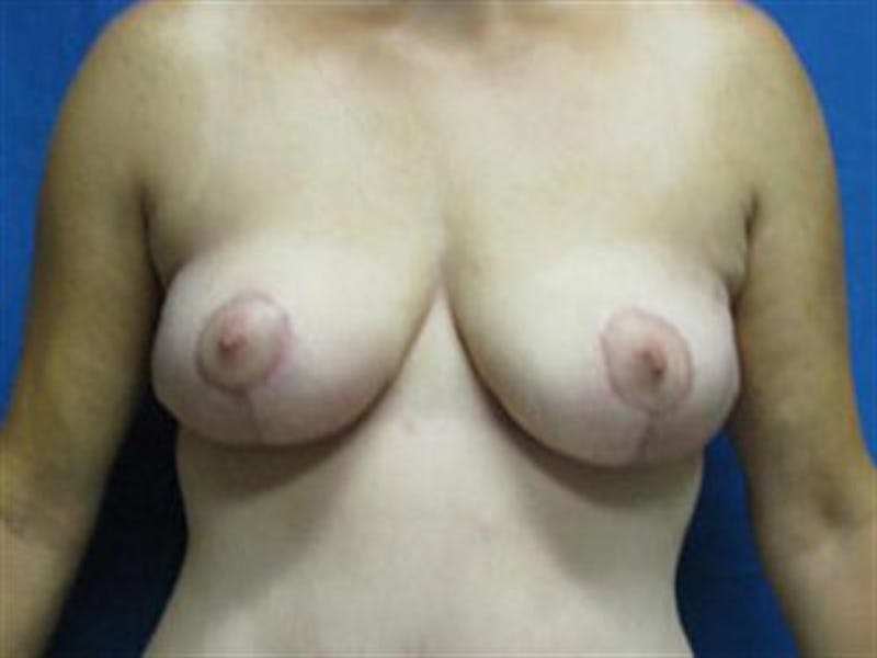 Breast Augmentation with Lift Before & After Gallery - Patient 344447 - Image 2