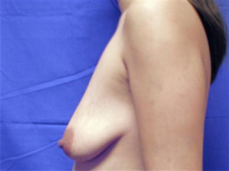 Breast Augmentation with Lift Before & After Gallery - Patient 243694 - Image 1
