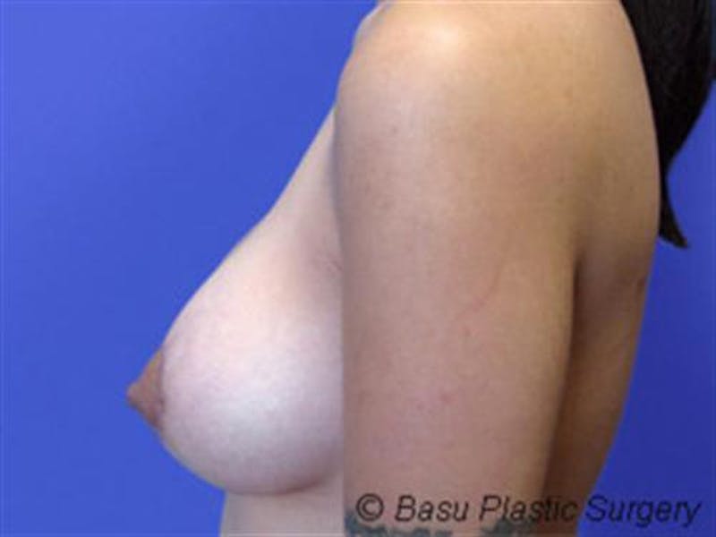 Breast Augmentation with Lift Before & After Gallery - Patient 243694 - Image 2