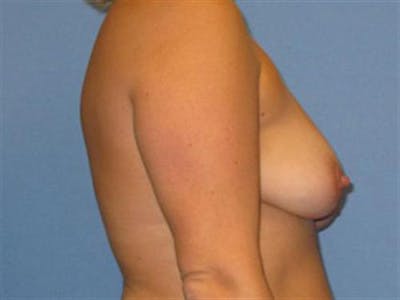 Breast Augmentation with Lift Before & After Gallery - Patient 139091 - Image 1