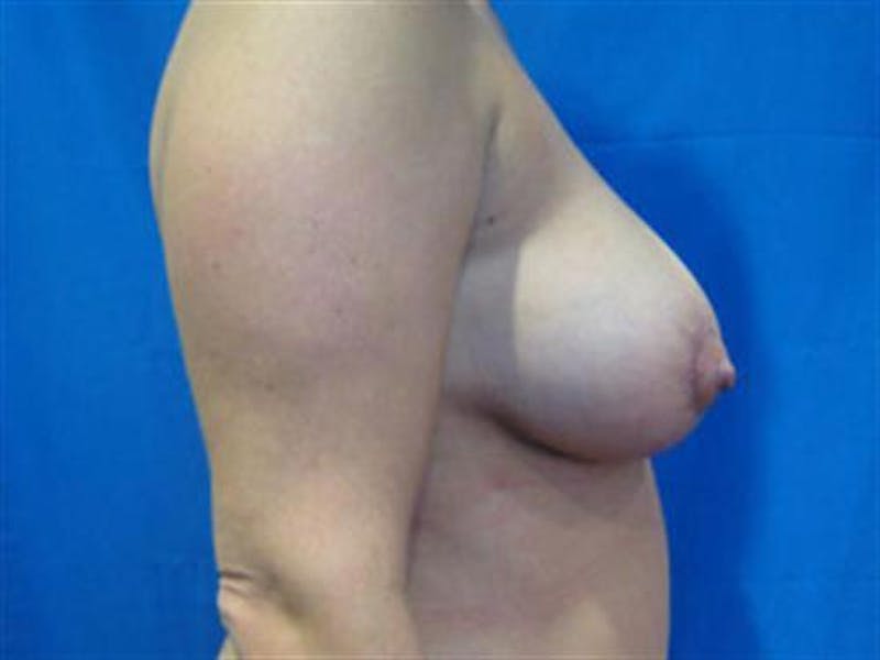 Breast Augmentation with Lift Before & After Gallery - Patient 139091 - Image 2
