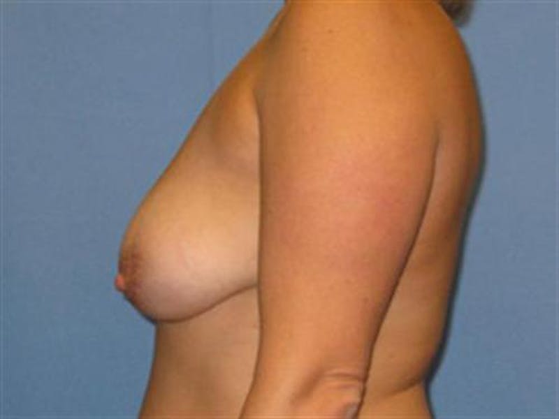 Breast Augmentation with Lift Before & After Gallery - Patient 139091 - Image 3