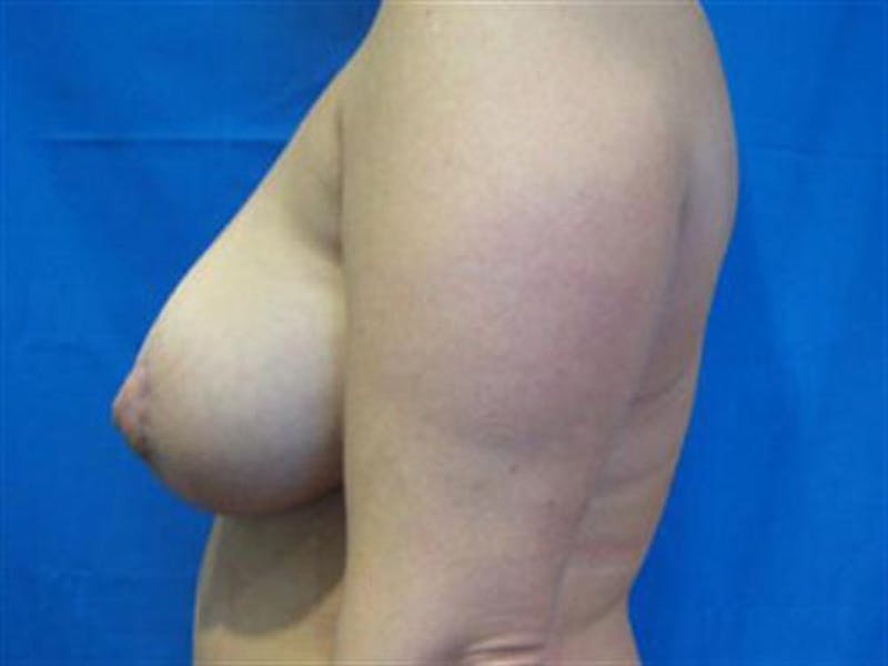 Breast Augmentation with Lift Before & After Gallery - Patient 139091 - Image 4
