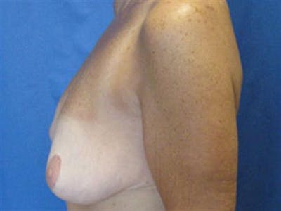Breast Augmentation with Lift Before & After Gallery - Patient 227753 - Image 1