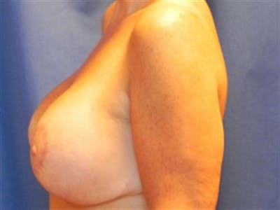 Breast Augmentation with Lift Before & After Gallery - Patient 227753 - Image 2