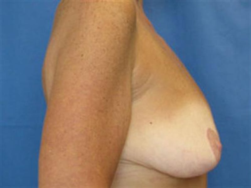 Breast Augmentation with Lift Before & After Gallery - Patient 227753 - Image 3