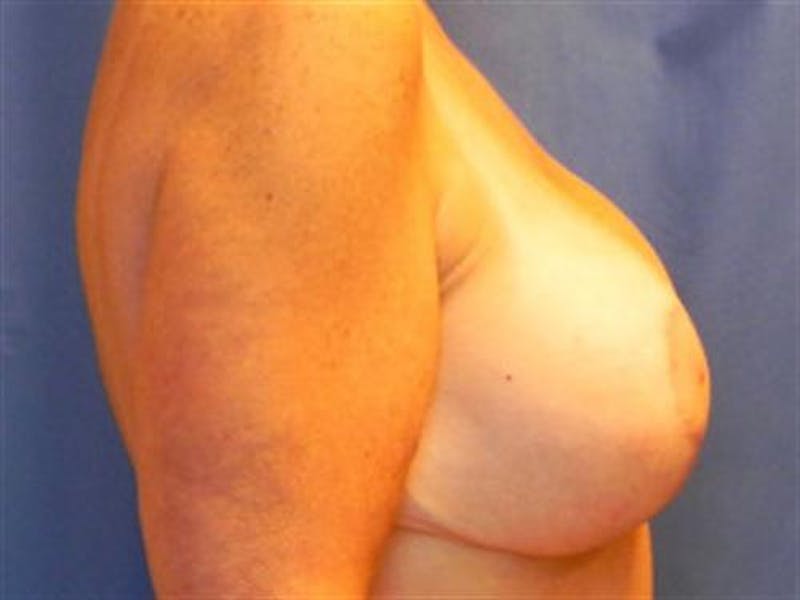 Breast Augmentation with Lift Before & After Gallery - Patient 227753 - Image 4