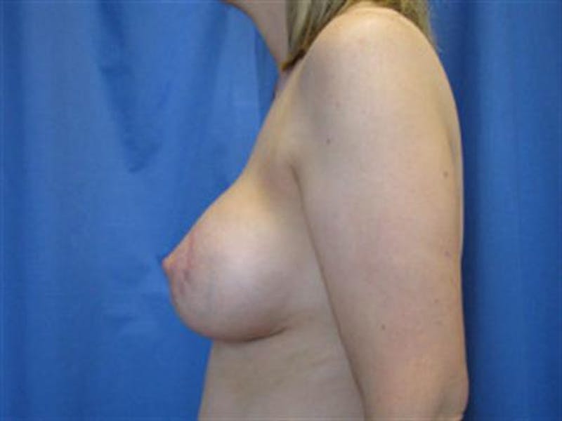 Breast Augmentation with Lift Before & After Gallery - Patient 399874 - Image 2