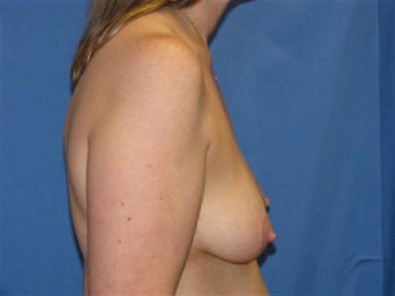 Breast Augmentation with Lift Before & After Gallery - Patient 399874 - Image 3