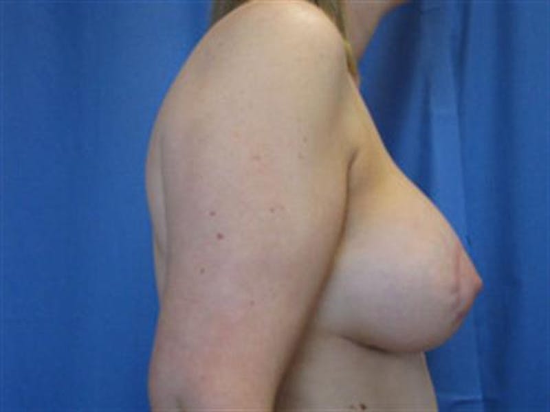 Breast Augmentation with Lift Before & After Gallery - Patient 399874 - Image 4