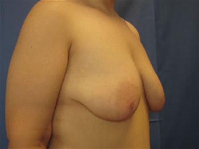 Breast Augmentation with Lift Before & After Gallery - Patient 408542 - Image 1