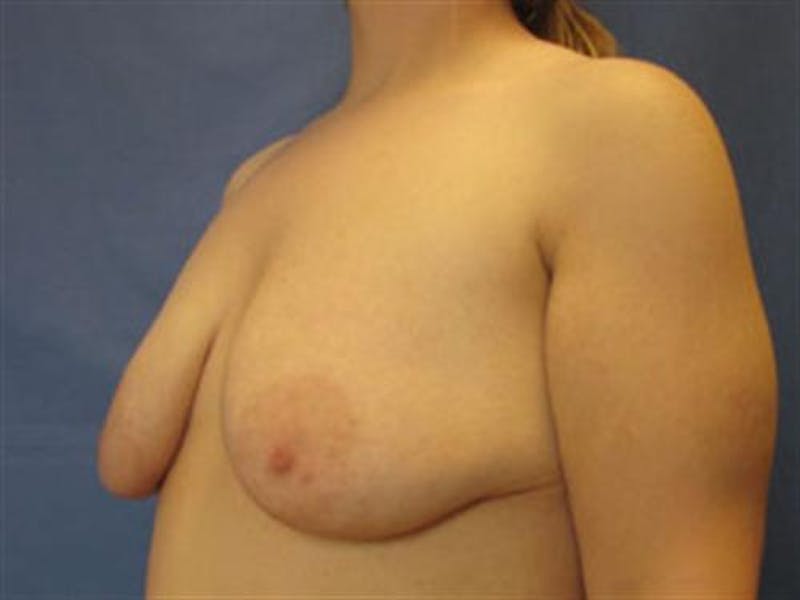 Breast Augmentation with Lift Before & After Gallery - Patient 408542 - Image 3