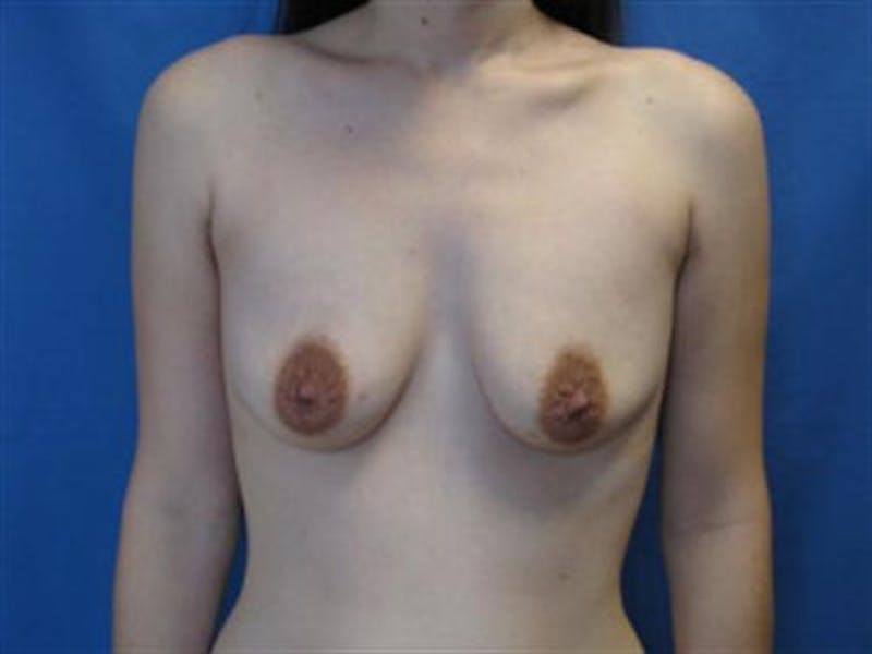 Breast Augmentation with Lift Before & After Gallery - Patient 815294 - Image 1