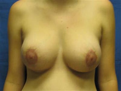 Breast Augmentation with Lift Before & After Gallery - Patient 284230 - Image 2