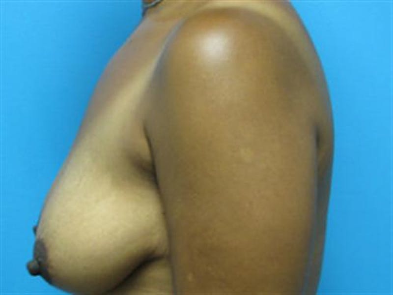Breast Augmentation with Lift Before & After Gallery - Patient 396512 - Image 1