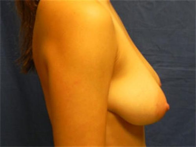 Breast Augmentation with Lift Before & After Gallery - Patient 116820 - Image 1