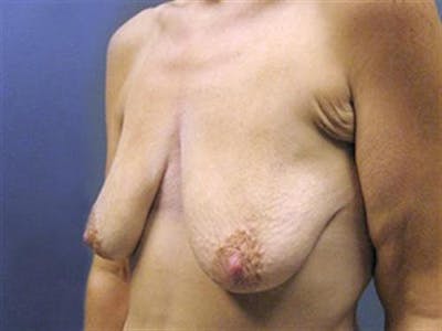 Breast Augmentation with Lift Before & After Gallery - Patient 392290 - Image 1