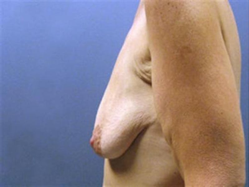 Breast Augmentation with Lift Before & After Gallery - Patient 392290 - Image 3