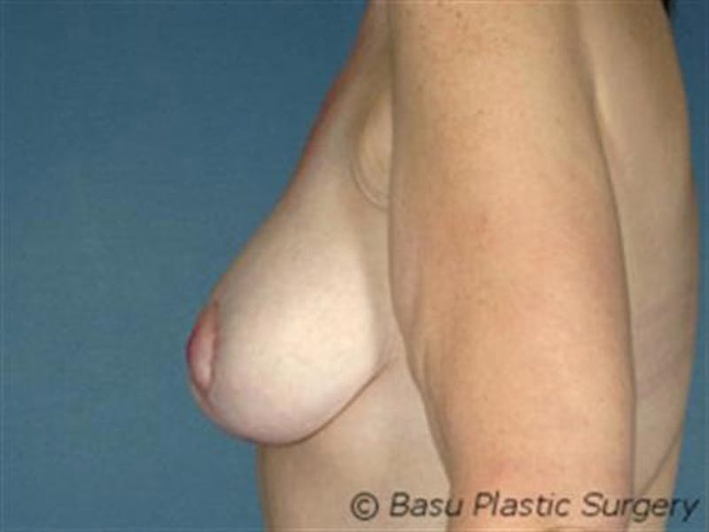 Breast Augmentation with Lift Before & After Gallery - Patient 392290 - Image 4