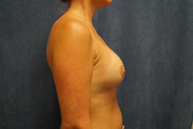 Breast Augmentation with Lift Before & After Gallery - Patient 411729 - Image 4