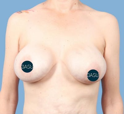 Breast Implant Revision Before & After Gallery - Patient 360904 - Image 1