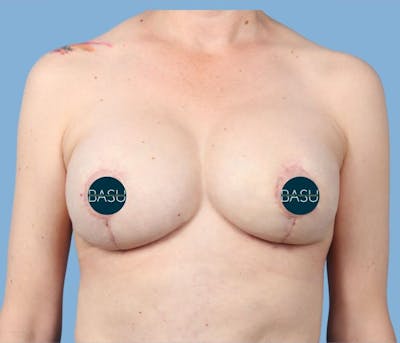 Breast Implant Revision Before & After Gallery - Patient 360904 - Image 2