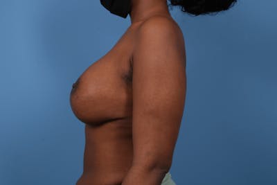 Breast Implant Revision Before & After Gallery - Patient 294803 - Image 1