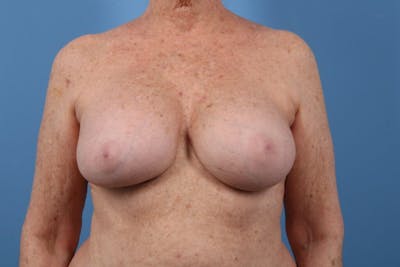 Breast Implant Revision Before & After Gallery - Patient 208461 - Image 1