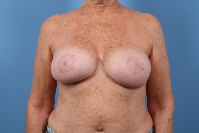 Breast Implant Revision Before & After Gallery - Patient 208461 - Image 2
