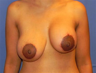 Breast Implant Revision Before & After Gallery - Patient 907541 - Image 1