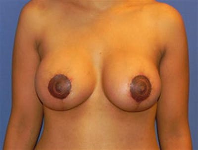 Breast Implant Revision Before & After Gallery - Patient 907541 - Image 2