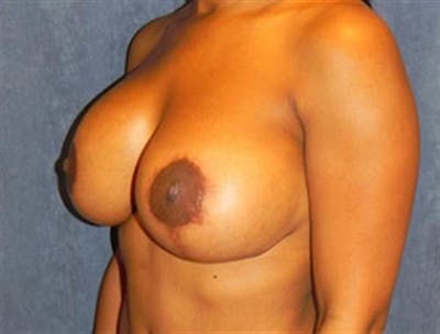 Breast Implant Revision Before & After Gallery - Patient 775767 - Image 2